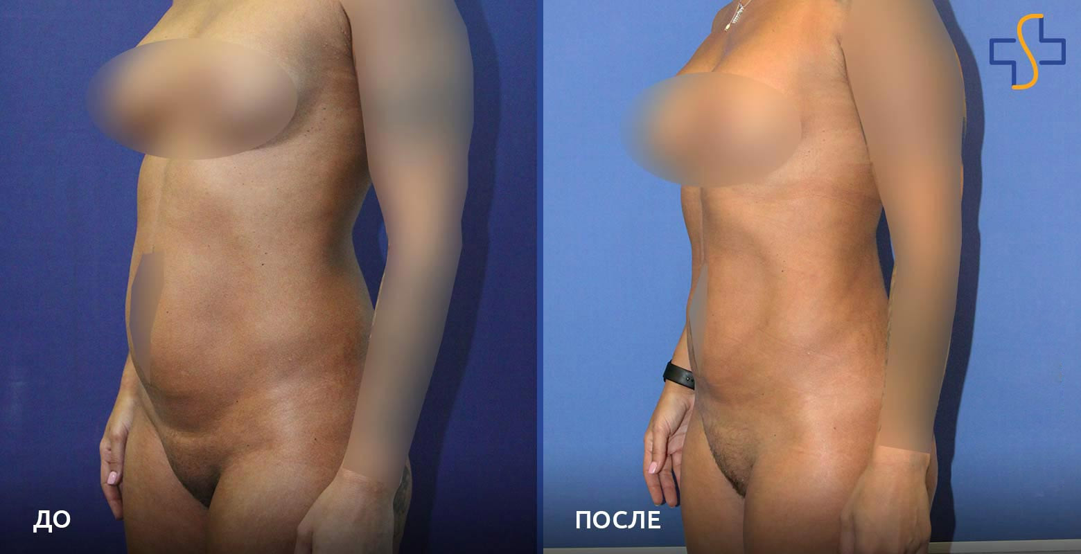 голая на операции фото до и после фото 60