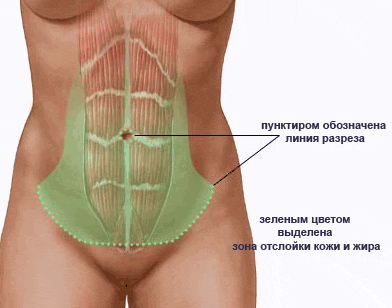Как восстановить живот после кесарева сечения: отвечают врачи и тренер - l2luna.ru