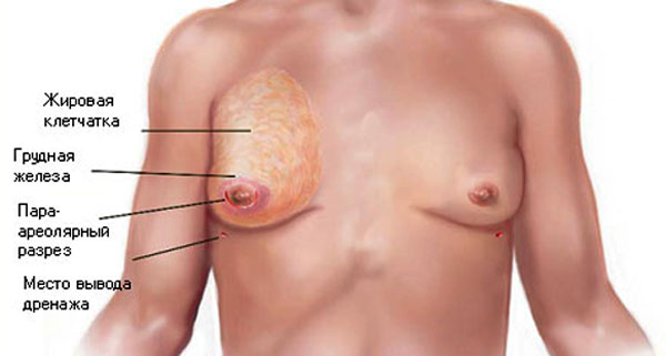 Мужская грудь: почему она растет, что делать, процесс лечения