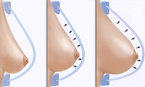 Пластика тубулярной груди