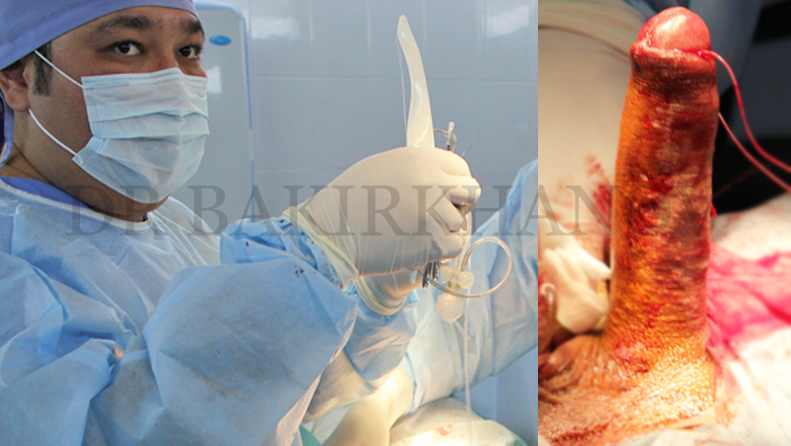 Фото до и после интимной пластики | Damas Medical Center