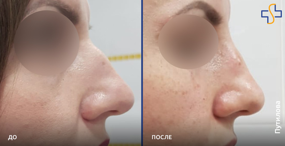 Как уменьшить нос хирургическим и безоперационным методом